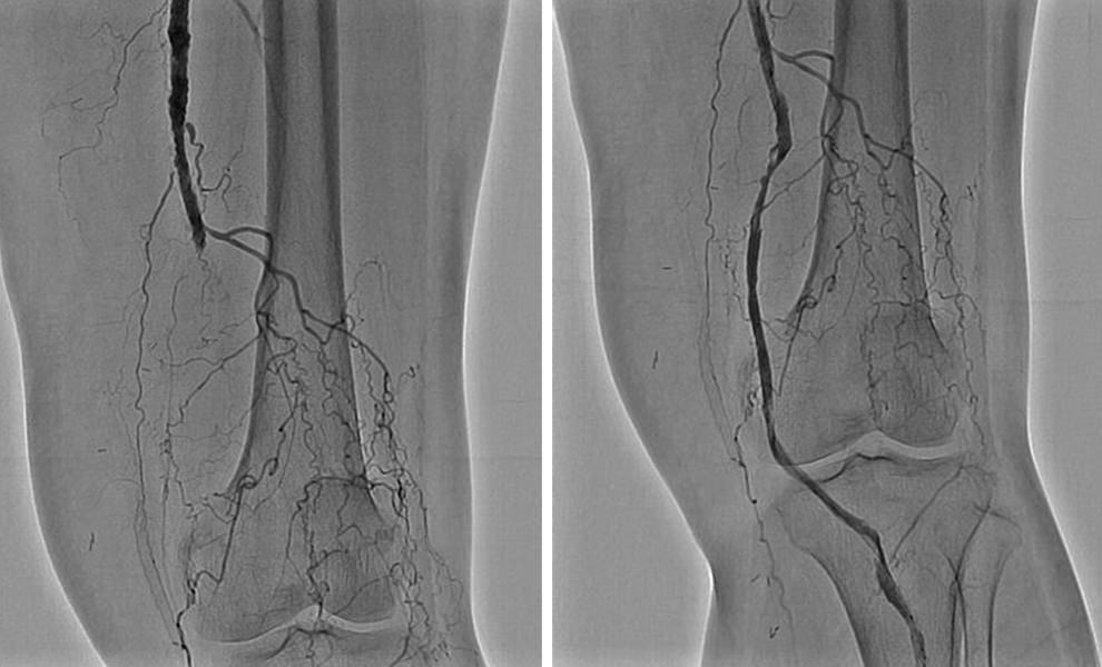 PADなしでPVDを行うことはできますか?